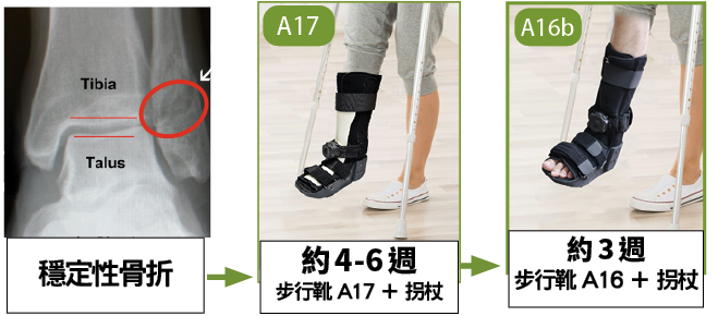 穩定性足踝骨折高身步行靴與短身步行靴復康流程